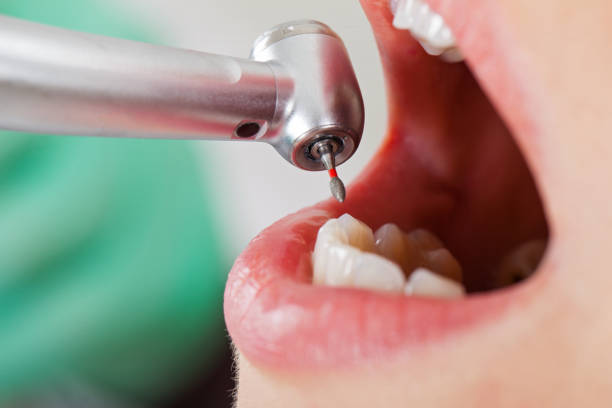 Best Emergency Wisdom Teeth Removal in Riverview, SC